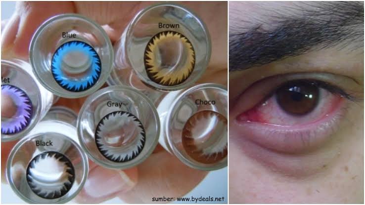 Waspada Iritasi Saat Pakai Softlens, Simak Cara Pemakaiannya yang Benar