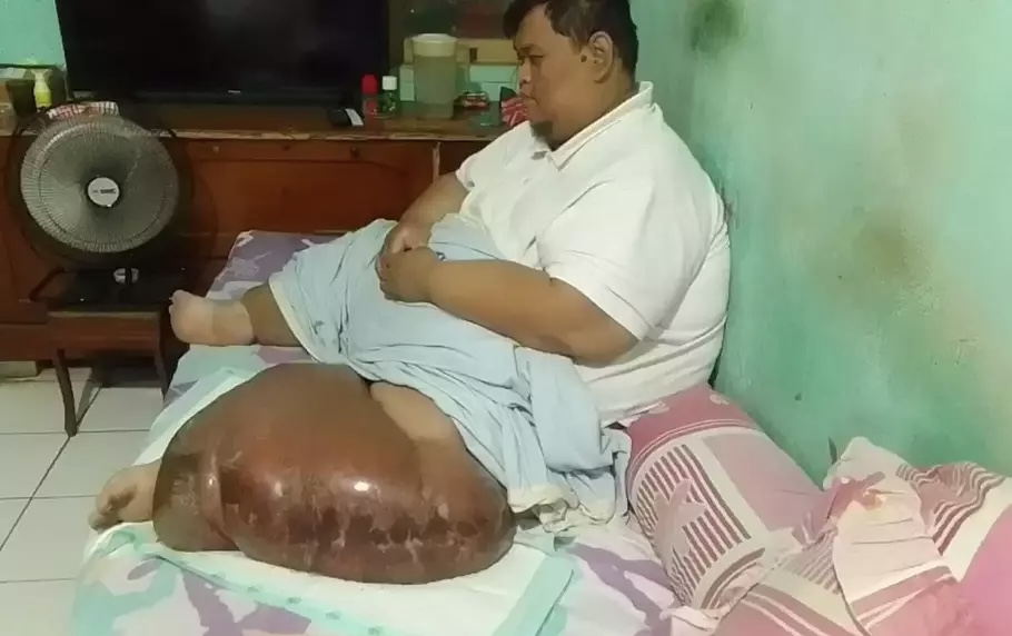 Perjuangan Pria Obesitas dengan Berat Badan 200 Kg di Kabupaten Tangerang