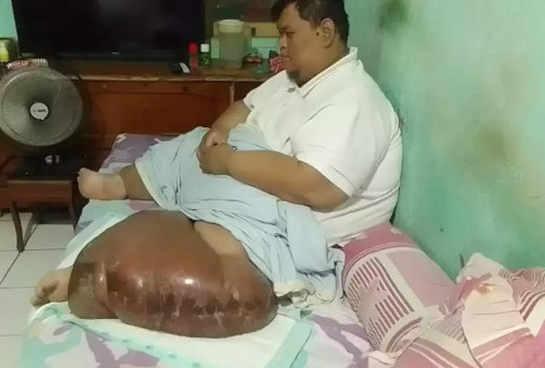 Perjuangan Pria Obesitas dengan Berat Badan 200 Kg di Kabupaten Tangerang